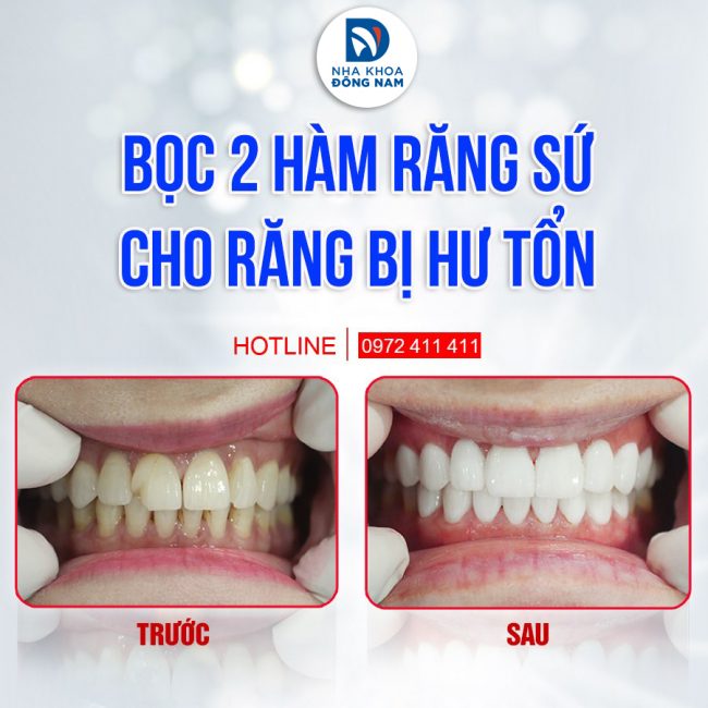 Top 10 địa chỉ bọc răng sứ thẩm mỹ tốt tại TPHCM
